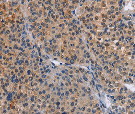 Immunohistochemistry of paraffin-embedded Human liver cancer tissue using MAP3K13 Polyclonal Antibody at dilution 1:40