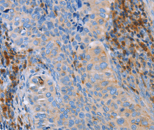 Immunohistochemistry of paraffin-embedded Human cervical cancer tissue using FNK Polyclonal Antibody at dilution 1:40