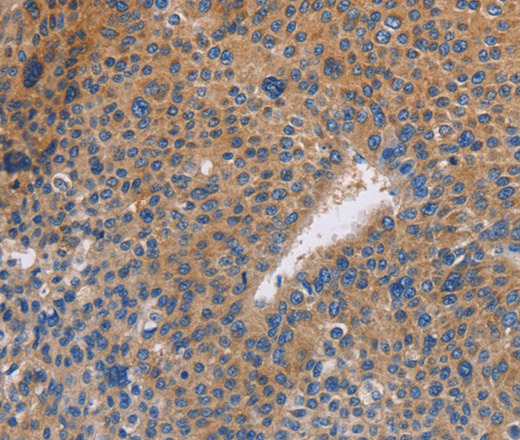 Immunohistochemistry of paraffin-embedded Human liver cancer tissue using NEK8 Polyclonal Antibody at dilution 1:30