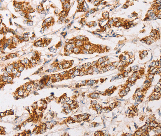 Immunohistochemistry of paraffin-embedded Human breast cancer using AK2 Polyclonal Antibody at dilution of 1:30