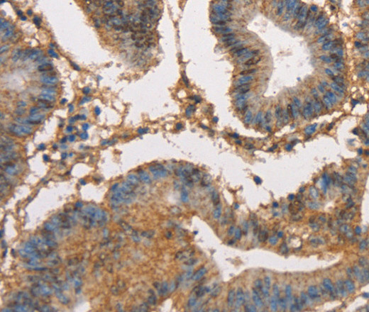 Immunohistochemistry of paraffin-embedded Human colon cancer tissue using HK3 Polyclonal Antibody at dilution 1:40