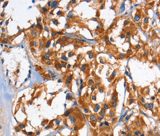 Immunohistochemistry of paraffin-embedded Human thyroid cancer using HK2 Polyclonal Antibody at dilution of 1:60