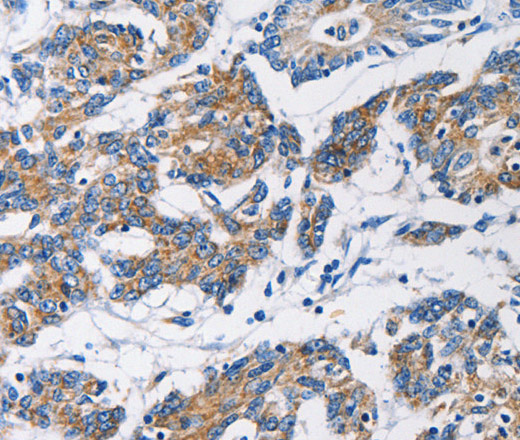 Immunohistochemistry of paraffin-embedded Human colon cancer tissue using HK1 Polyclonal Antibody at dilution 1:50