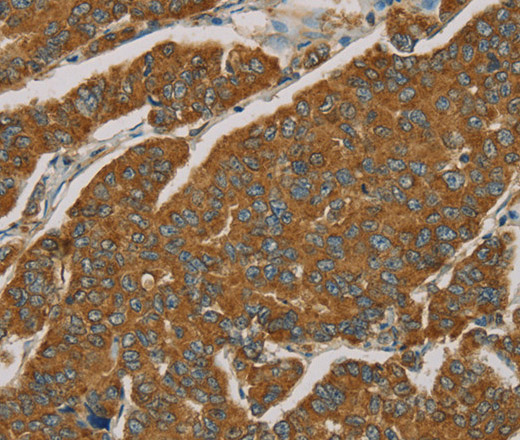 Immunohistochemistry of paraffin-embedded Human breast cancer tissue using NPPB Polyclonal Antibody at dilution 1:30