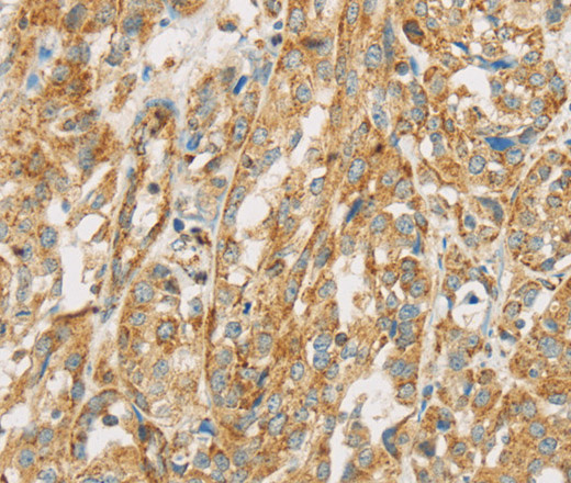 Immunohistochemistry of paraffin-embedded Human esophagus cancer tissue using NPPB Polyclonal Antibody at dilution 1:30