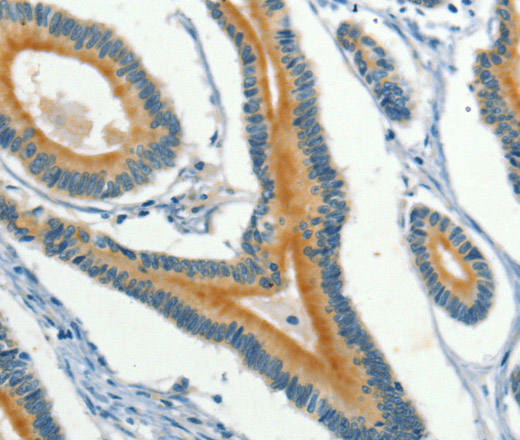 Immunohistochemistry of paraffin-embedded Human colon cancer using KLC1 Polyclonal Antibody at dilution of 1:40