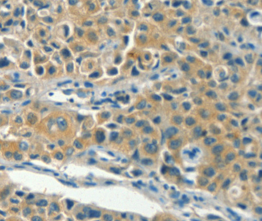 Immunohistochemistry of paraffin-embedded Human lung cancer using KLC1 Polyclonal Antibody at dilution of 1:40