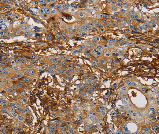 Immunohistochemistry of paraffin-embedded Human gastic cancer using CD54 Polyclonal Antibody at dilution of 1:50