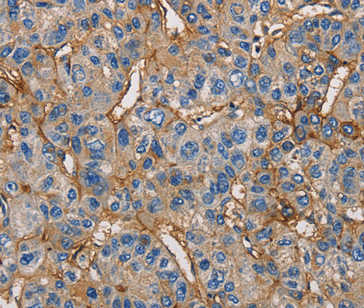 Immunohistochemistry of paraffin-embedded Human liver cancer using CD54 Polyclonal Antibody at dilution of 1:50