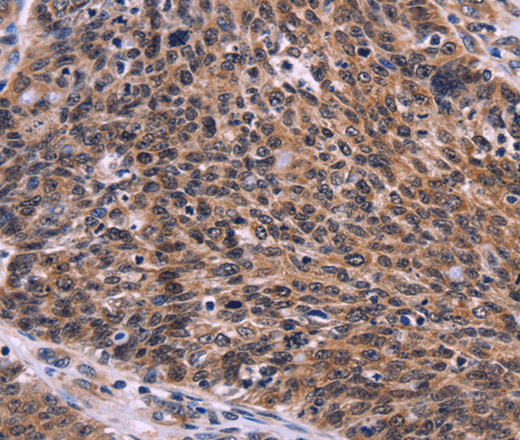 Immunohistochemistry of paraffin-embedded Human ovarian cancer tissue using CDC5L Polyclonal Antibody at dilution 1:30