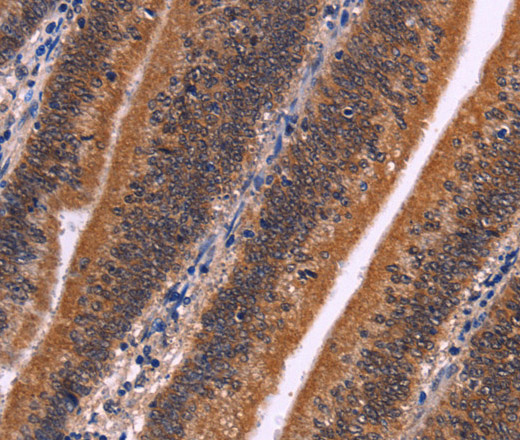 Immunohistochemistry of paraffin-embedded Human colon cancer tissue using CDC5L Polyclonal Antibody at dilution 1:30