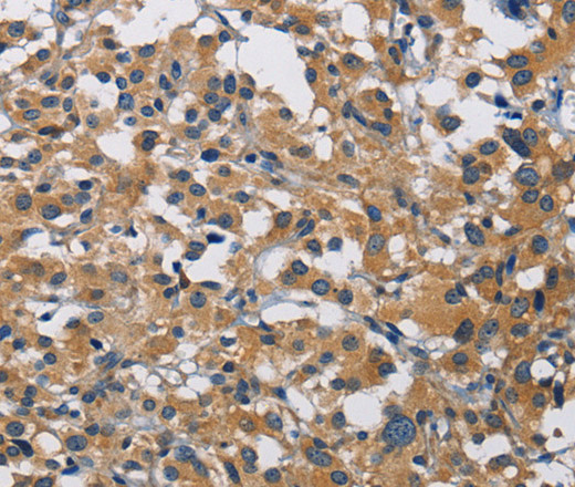 Immunohistochemistry of paraffin-embedded Human thyroid cancer tissue using CST4 Polyclonal Antibody at dilution 1:60