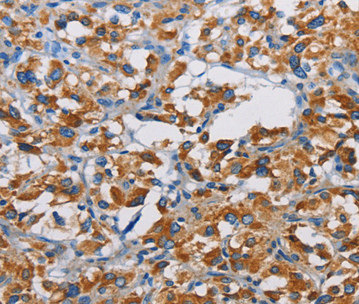 Immunohistochemistry of paraffin-embedded Human thyroid cancer tissue using TSPEAR Polyclonal Antibody at dilution 1:50