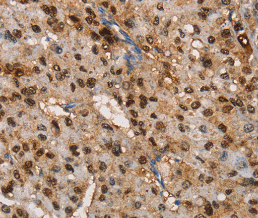 Immunohistochemistry of paraffin-embedded Human liver cancer tissue using TSPEAR Polyclonal Antibody at dilution 1:50