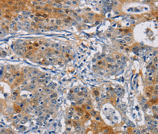 Immunohistochemistry of paraffin-embedded Human gastric cancer tissue using GSTA2 Polyclonal Antibody at dilution 1:50