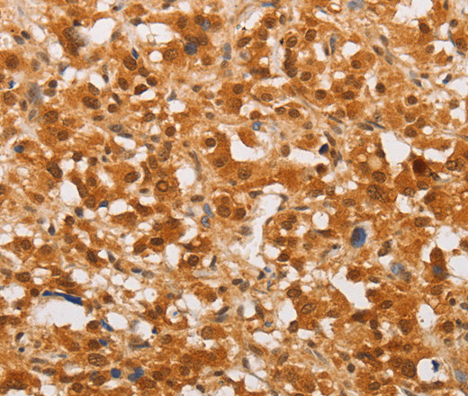 Immunohistochemistry of paraffin-embedded Human thyroid cancer using THOC7 Polyclonal Antibody at dilution of 1:30