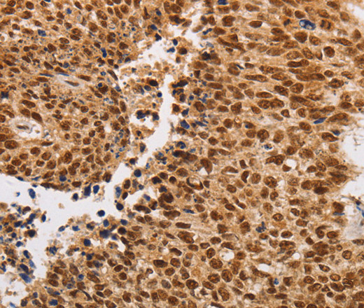 Immunohistochemistry of paraffin-embedded Human lung cancer using THOC7 Polyclonal Antibody at dilution of 1:30