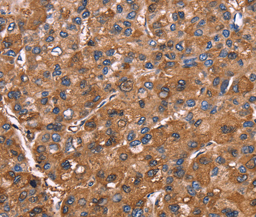 Immunohistochemistry of paraffin-embedded Human liver cancer tissue using ELP2 Polyclonal Antibody at dilution 1:40