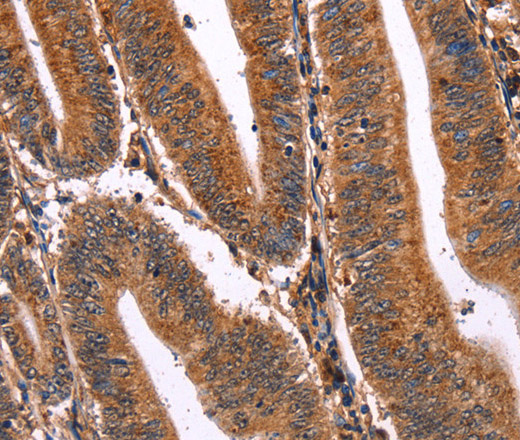 Immunohistochemistry of paraffin-embedded Human colon cancer tissue using ELP2 Polyclonal Antibody at dilution 1:40