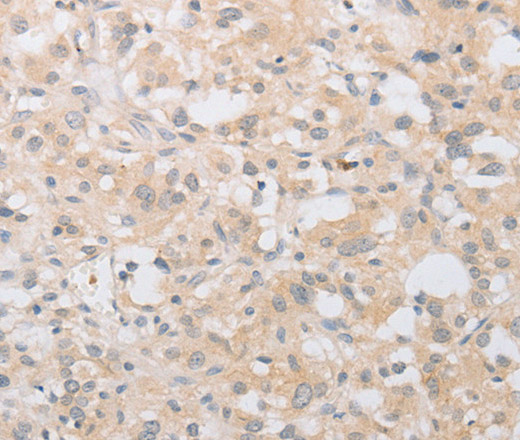 Immunohistochemistry of paraffin-embedded Human thyroid cancer using ATG9A Polyclonal Antibody at dilution of 1:30