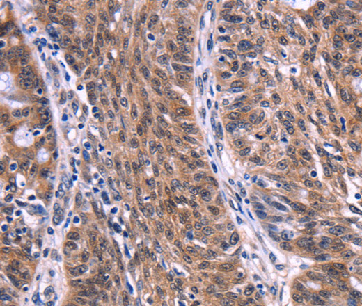 Immunohistochemistry of paraffin-embedded Human ovarian cancer tissue using EIF2AK4 Polyclonal Antibody at dilution 1:50