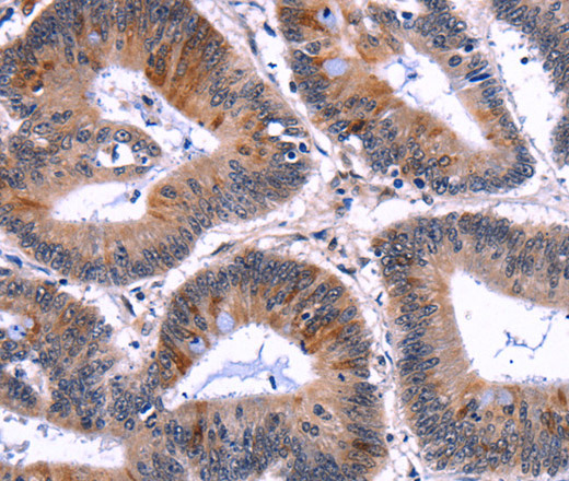 Immunohistochemistry of paraffin-embedded Human colon cancer tissue using EIF2AK4 Polyclonal Antibody at dilution 1:50