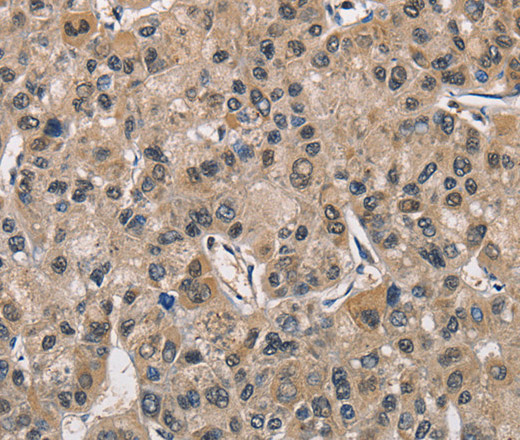 Immunohistochemistry of paraffin-embedded Human liver cancer using PGK1 Polyclonal Antibody at dilution of 1:40