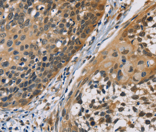 Immunohistochemistry of paraffin-embedded Human cervical cancer using CBR1 Polyclonal Antibody at dilution of 1:40