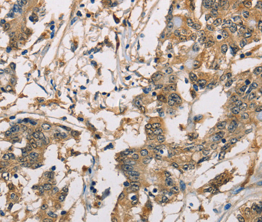 Immunohistochemistry of paraffin-embedded Human colon cancer using CBR1 Polyclonal Antibody at dilution of 1:40