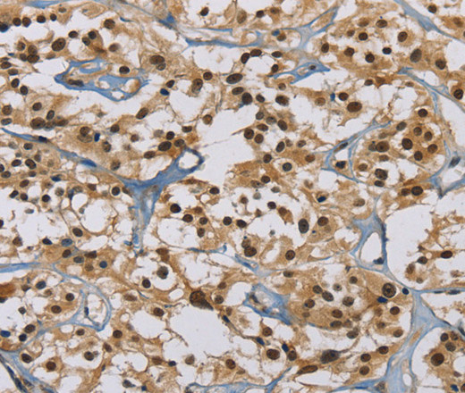 Immunohistochemistry of paraffin-embedded Human thyroid cancer tissue using ACVR1 Polyclonal Antibody at dilution 1:60