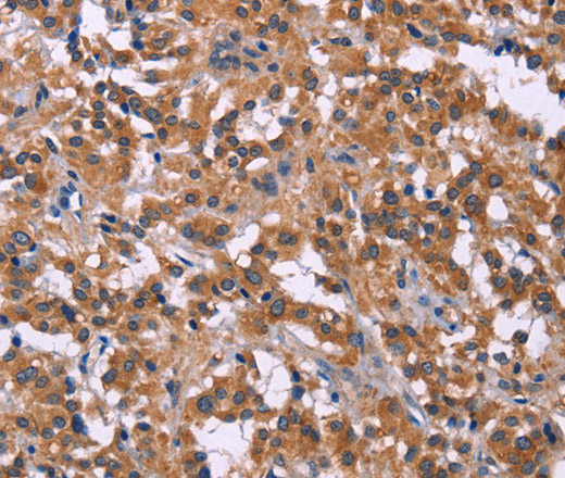 Immunohistochemistry of paraffin-embedded Human thyroid cancer tissue using PIP5K1B Polyclonal Antibody at dilution 1:30