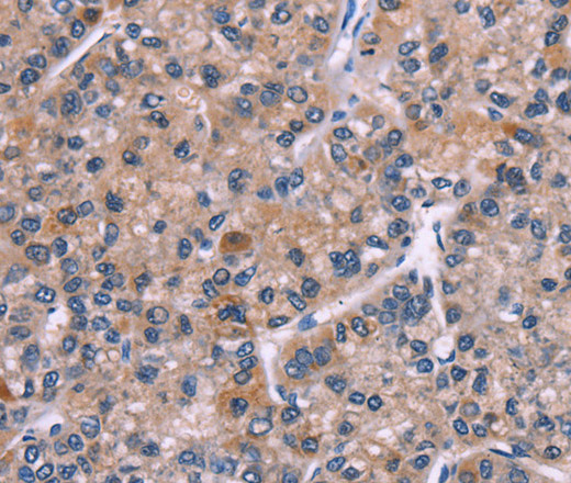 Immunohistochemistry of paraffin-embedded Human liver cancer tissue using PIP5K1B Polyclonal Antibody at dilution 1:30