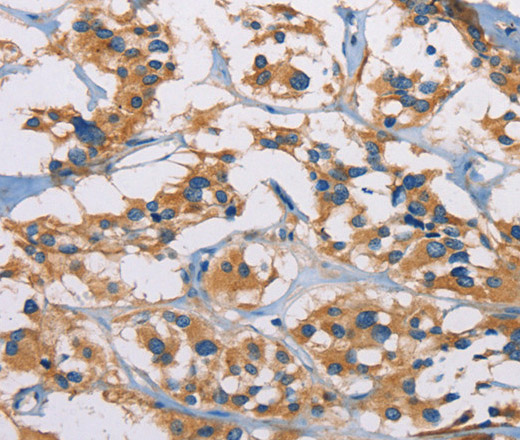 Immunohistochemistry of paraffin-embedded Human thyroid cancer tissue using CERK Polyclonal Antibody at dilution 1:50