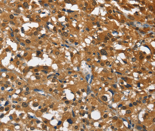 Immunohistochemistry of paraffin-embedded Human thyroid cancer tissue using DRAK2 Polyclonal Antibody at dilution 1:40