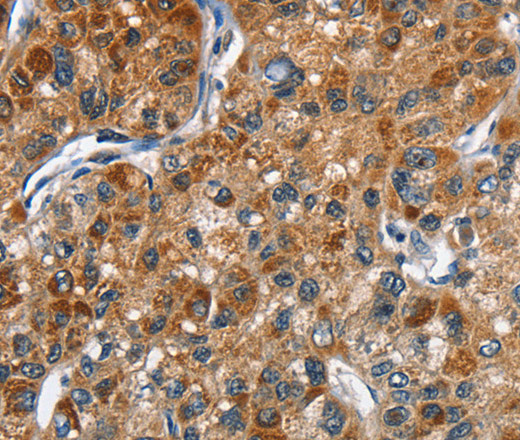 Immunohistochemistry of paraffin-embedded Human liver cancer tissue using DRAK2 Polyclonal Antibody at dilution 1:40