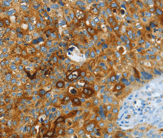 Immunohistochemistry of paraffin-embedded Human cervical cancer using ASAH1 Polyclonal Antibody at dilution of 1:40