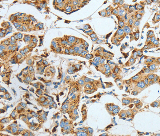 Immunohistochemistry of paraffin-embedded Human breast cancer using ASAH1 Polyclonal Antibody at dilution of 1:40