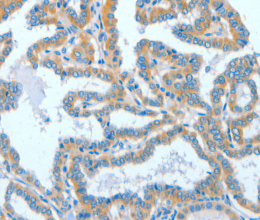 Immunohistochemistry of paraffin-embedded Human thyroid cancer tissue using ASCC1 Polyclonal Antibody at dilution 1:50