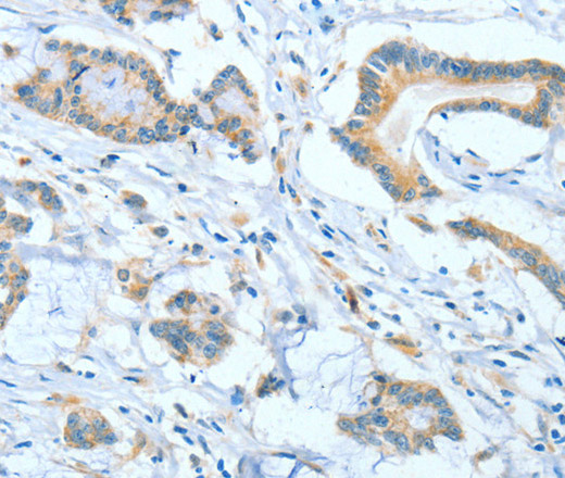 Immunohistochemistry of paraffin-embedded Human colon cancer tissue using ASCC1 Polyclonal Antibody at dilution 1:50