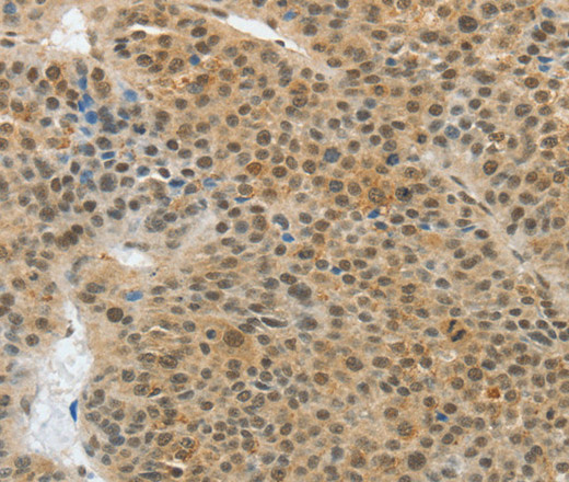 Immunohistochemistry of paraffin-embedded Human liver cancer tissue using ASH2L Polyclonal Antibody at dilution 1:50