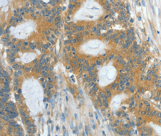 Immunohistochemistry of paraffin-embedded Human colon cancer using ASPA Polyclonal Antibody at dilution of 1:60