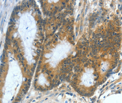 Immunohistochemistry of paraffin-embedded Human colon cancer using ASNS Polyclonal Antibody at dilution of 1:50