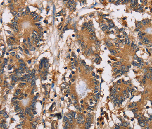 Immunohistochemistry of paraffin-embedded Human colon cancer using HTR3C Polyclonal Antibody at dilution of 1:40