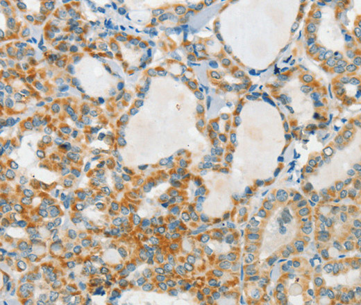 Immunohistochemistry of paraffin-embedded Human thyroid cancer tissue using AANAT Polyclonal Antibody at dilution 1:40