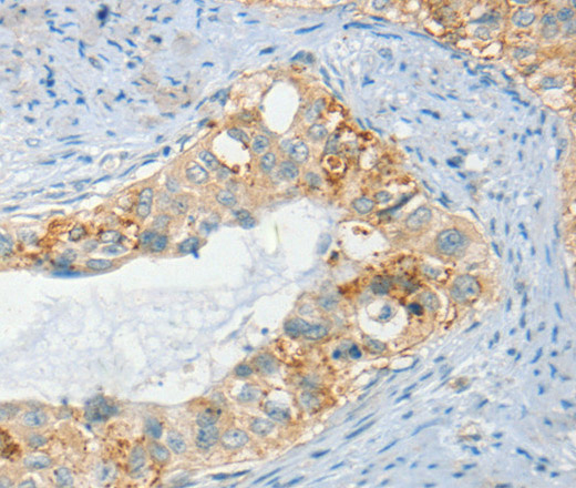 Immunohistochemistry of paraffin-embedded Human cervical cancer tissue using AANAT Polyclonal Antibody at dilution 1:40