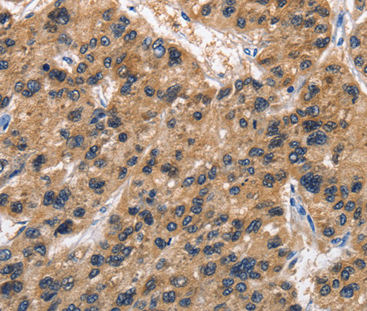 Immunohistochemistry of paraffin-embedded Human liver cancer tissue using ABI3BP Polyclonal Antibody at dilution 1:50