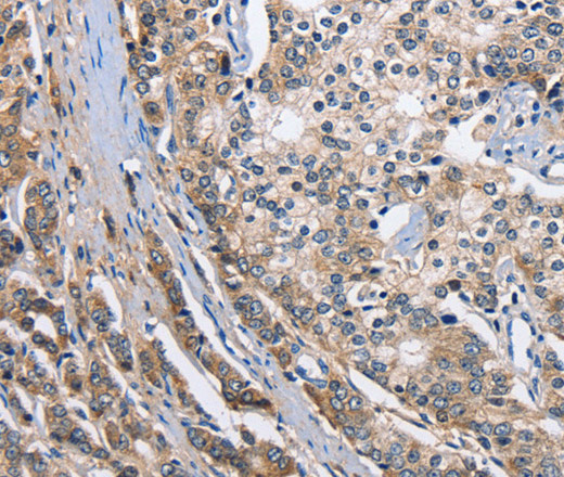 Immunohistochemistry of paraffin-embedded Human prostate cancer tissue using ABI3BP Polyclonal Antibody at dilution 1:50