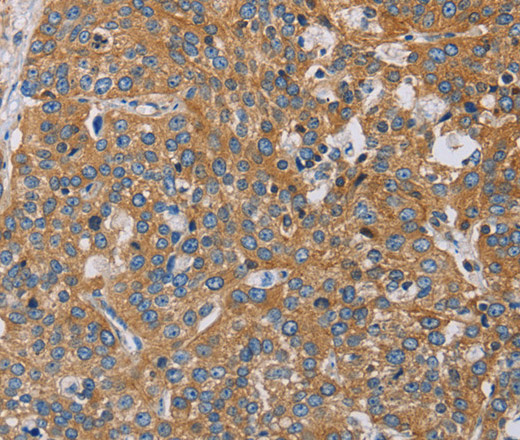 Immunohistochemistry of paraffin-embedded Human esophagus cancer using ACTN4 Polyclonal Antibody at dilution of 1:60