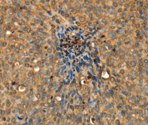 Immunohistochemistry of paraffin-embedded Human cervical cancer tissue using ADCY3 Polyclonal Antibody at dilution 1:30