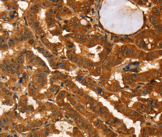 Immunohistochemistry of paraffin-embedded Human thyroid cancer tissue using IKZF3 Polyclonal Antibody at dilution 1:60